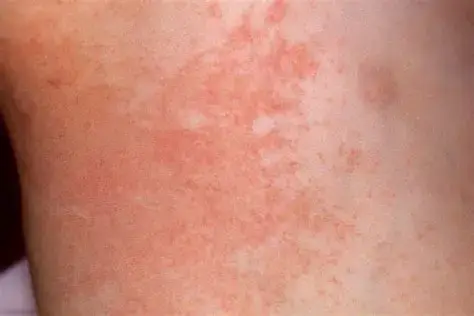 Close-up photo of skin covered in a fine red rash of small bumps typical of heat rash.