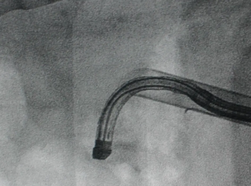 X-ray image showing a flexible scope inside the kidney, its tip bent sharply back on itself.