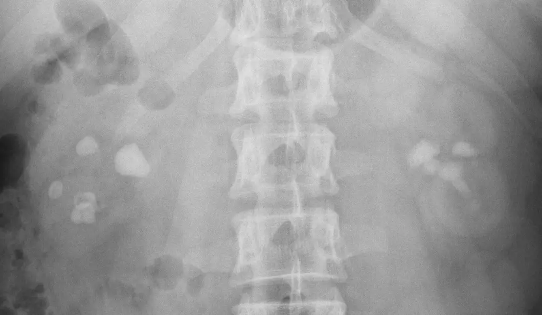 Abdominal X-ray showing several white stones scattered in both kidneys on either side of the spine.