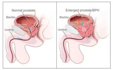 Two side views of the bladder and prostate. On the left a normal prostate; on the right an enlarged prostate squeezing the urethra.