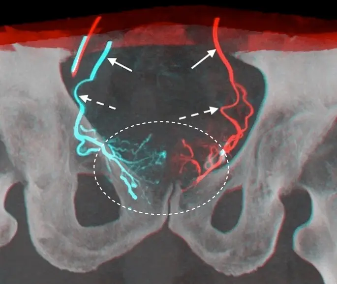 Scan image of the pelvis showing the small arteries that feed the prostate, highlighted in blue and red on each side.