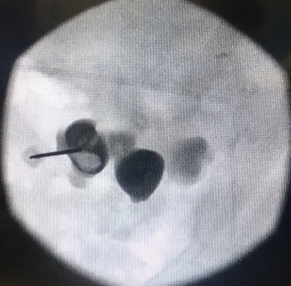 X-ray image of a kidney filled with contrast dye, with a puncture needle aimed at one of the calyces.