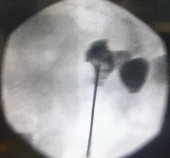 X-ray image showing a straight needle entering a contrast-filled calyx from below.