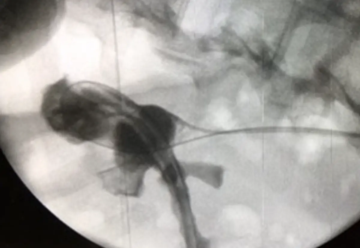 X-ray image of a kidney filled with contrast dye, with a tube in place, at the end of surgery.