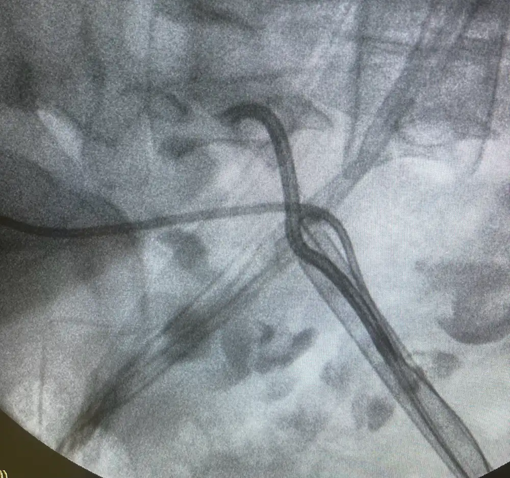 X-ray image showing a flexible telescope passing through a sheath into the drainage system of a horseshoe kidney.