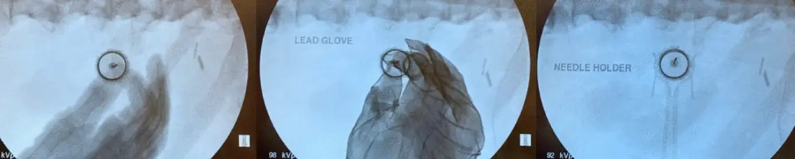 Three X-ray images comparing a gloved hand, a lead-gloved hand and a metal needle holder in the X-ray field.