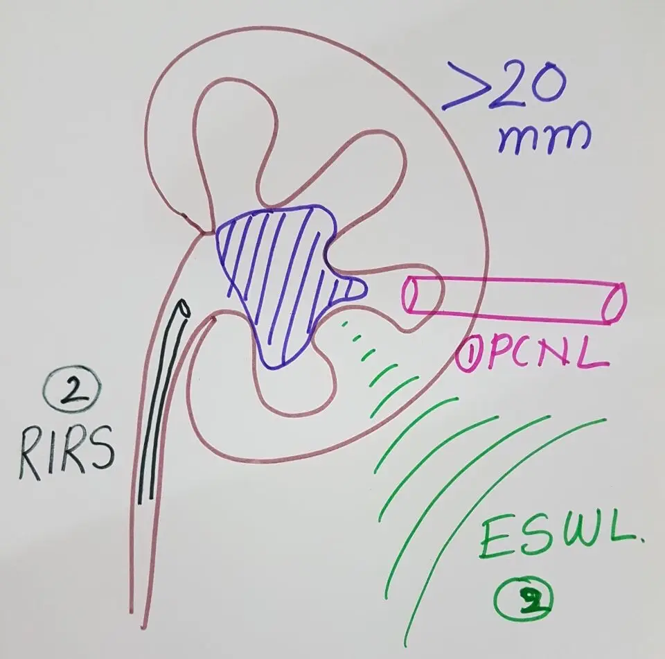Hand-drawn sketch of a kidney with a large stone, marked over 20 mm, showing three routes: PCNL through the back, RIRS up through the ureter, and ESWL shock waves from outside.