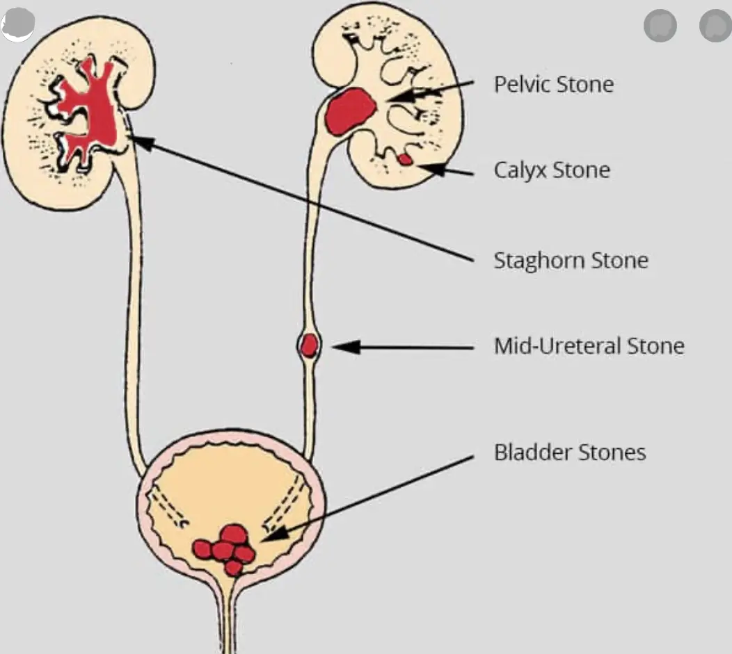 Diagram of both kidneys, the ureters and the bladder, marking a staghorn stone, a pelvic stone, a calyx stone, a mid-ureteral stone and bladder stones.