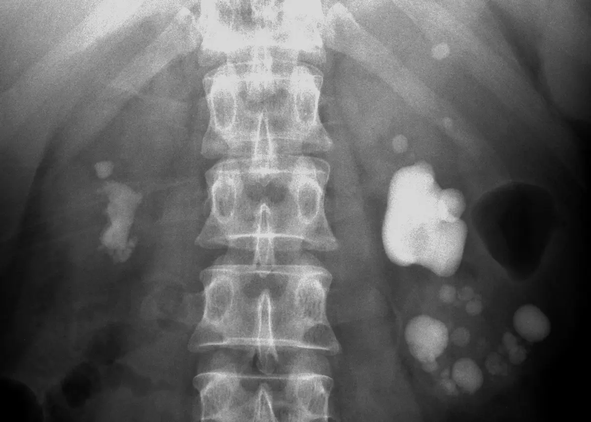 Abdominal X-ray showing several bright white stones in both kidneys, larger on the left side.