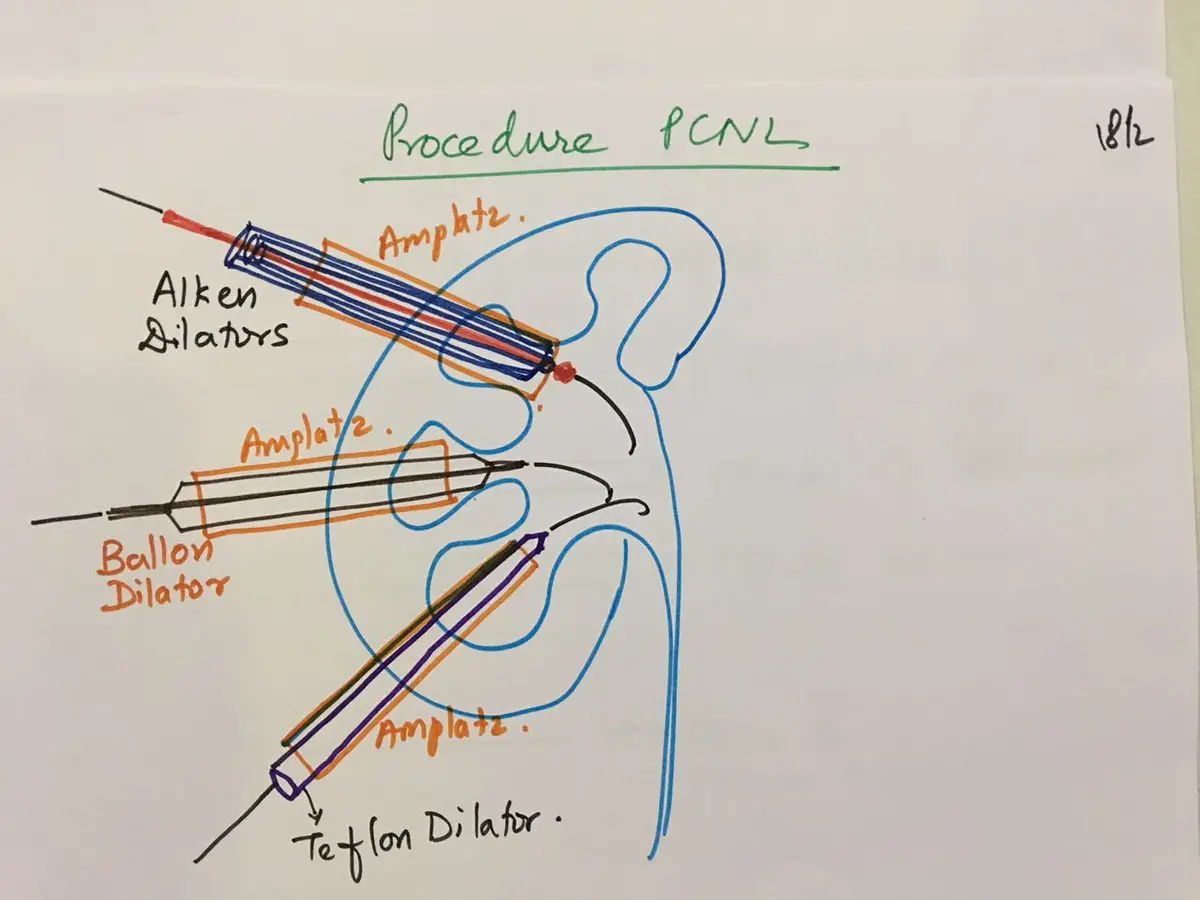 Hand-drawn kidney with three tracts, each showing a different dilator with an Amplatz sheath over it: Alken dilators, a balloon dilator and a Teflon dilator.