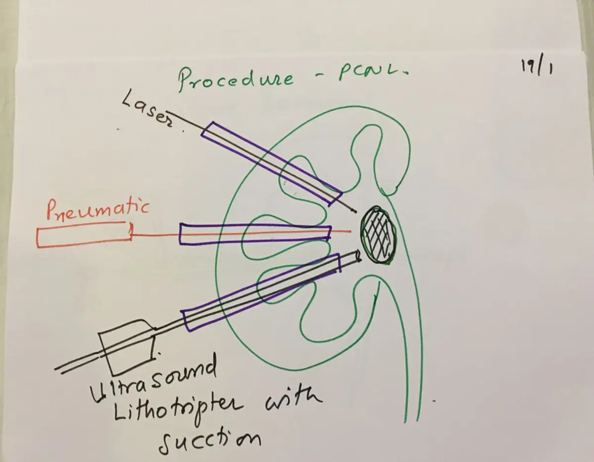 Hand-drawn kidney with a stone being reached by three instruments labelled laser, pneumatic, and ultrasound lithotripter with suction.
