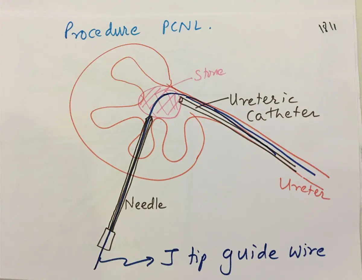 Hand-drawn kidney with a stone, a needle entering from below, a J-tip guide wire passing down the ureter, and a ureteric catheter alongside it.