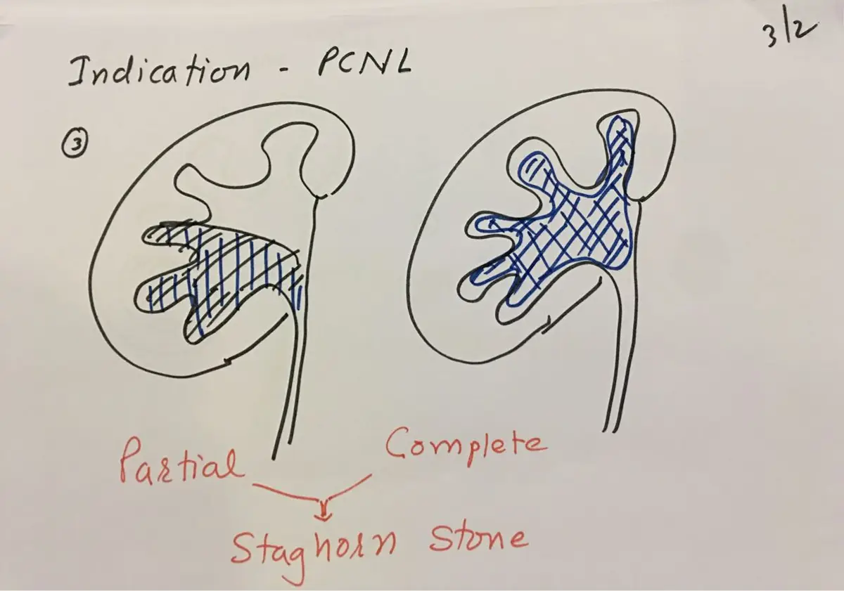 Two hand-drawn kidneys, one with a stone filling part of the collecting system and one with a stone filling all of it, labelled partial and complete staghorn stone.