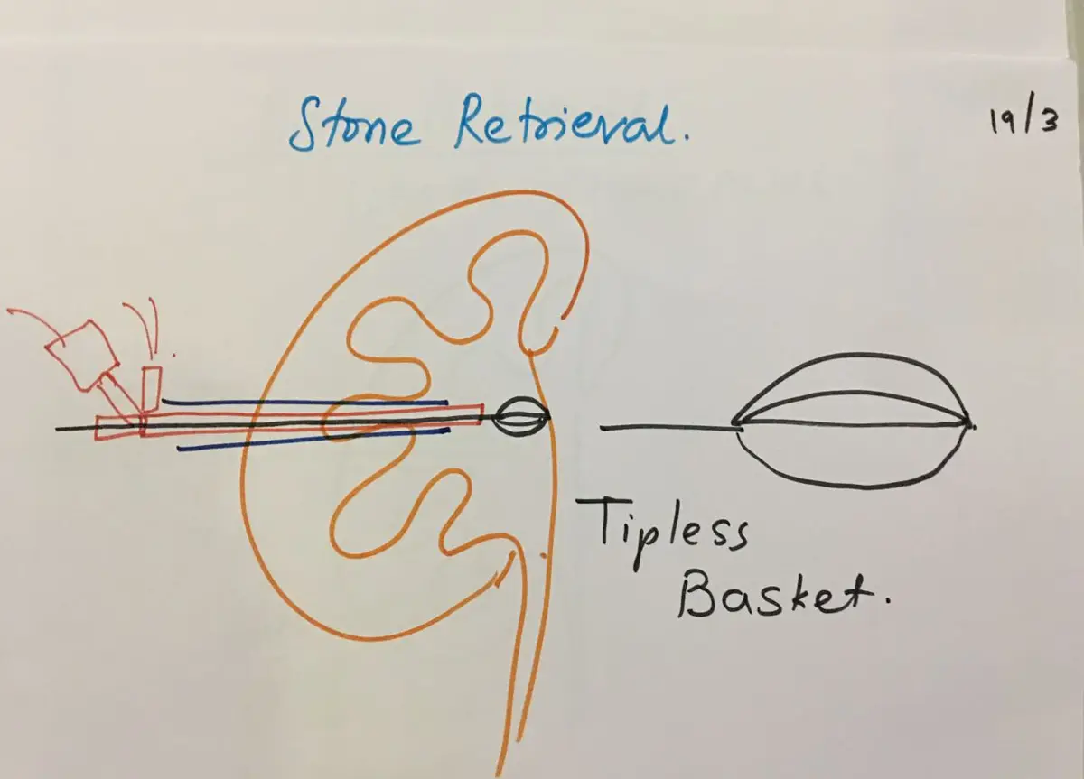 Hand-drawn kidney with a nephroscope inside and a wire basket at its tip, with an enlarged drawing of the basket beside it labelled tipless basket.
