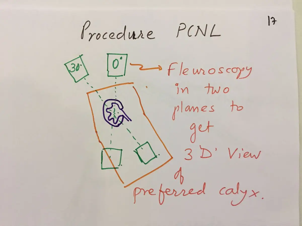 Hand-drawn sketch of a patient's outline with two X-ray positions marked 0 degrees and 30 degrees, labelled fluoroscopy in two planes to get a 3D view of the preferred calyx.