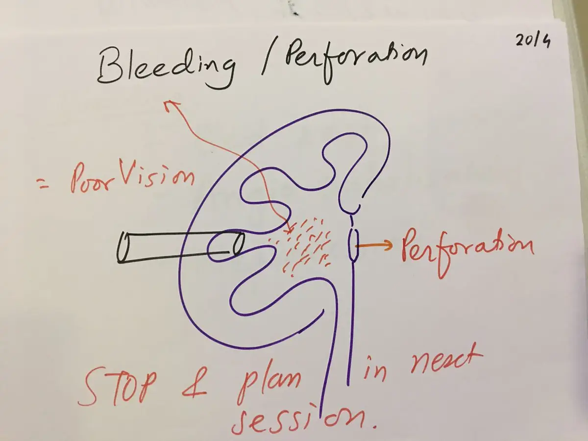 Hand-drawn kidney showing bleeding around the tract and a perforation, with the note to stop and plan the next session.