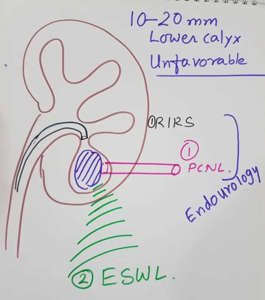 Hand-drawn kidney with a lower calyx stone, labelled first PCNL, then RIRS, then ESWL, for unfavourable anatomy.