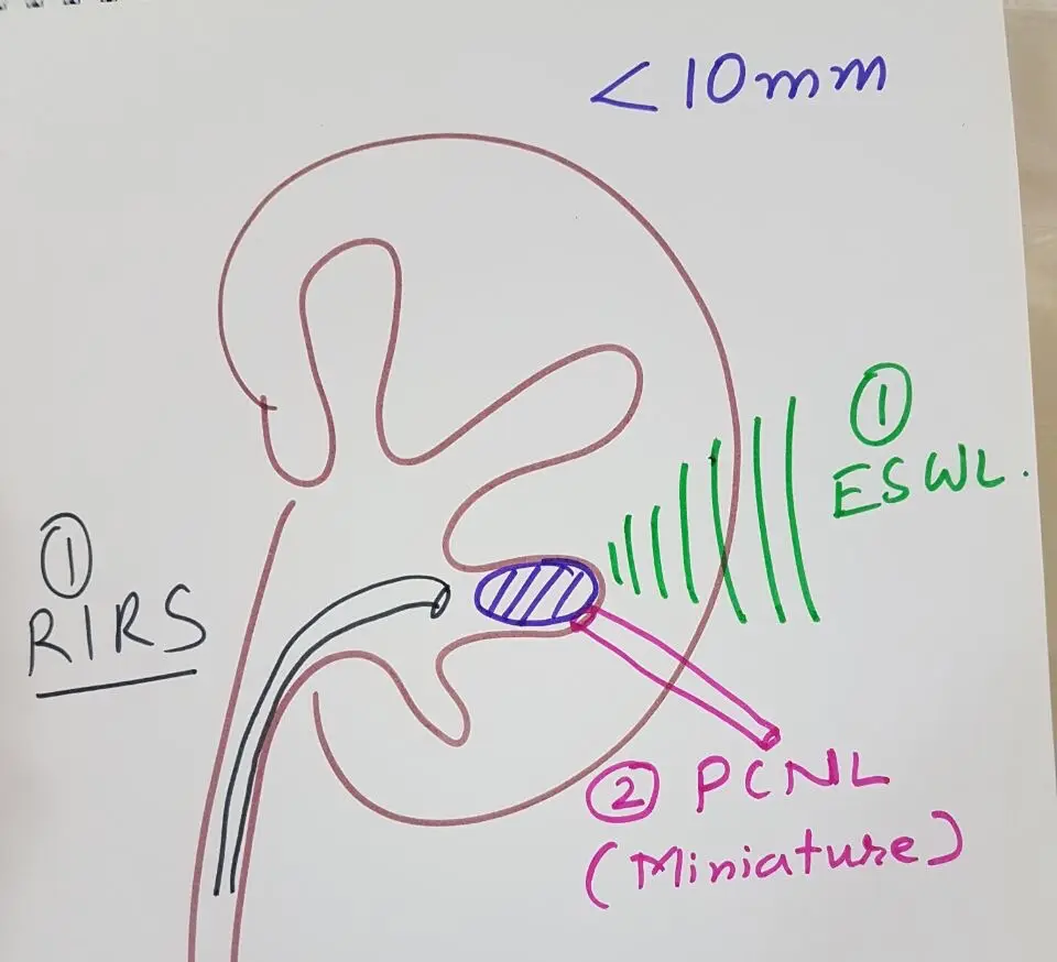 Hand-drawn kidney with a small stone, labelled first RIRS or ESWL, second miniaturised PCNL, for stones under 10 mm.