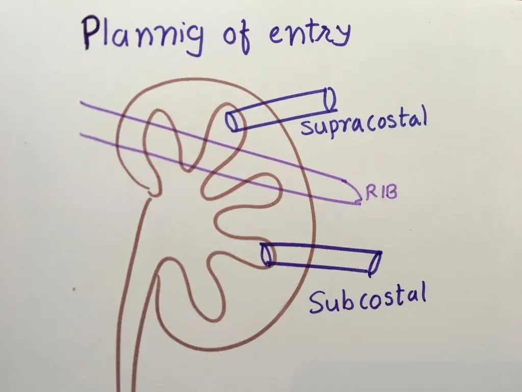 Hand-drawn kidney showing two access tracts, one passing above the rib and one below it.