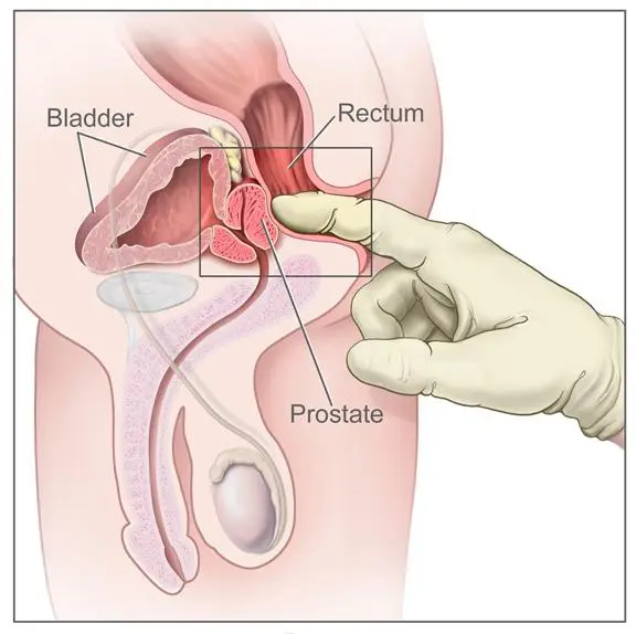 Medical drawing of a gloved finger in the rectum feeling the back of the prostate, with the bladder and rectum labelled.