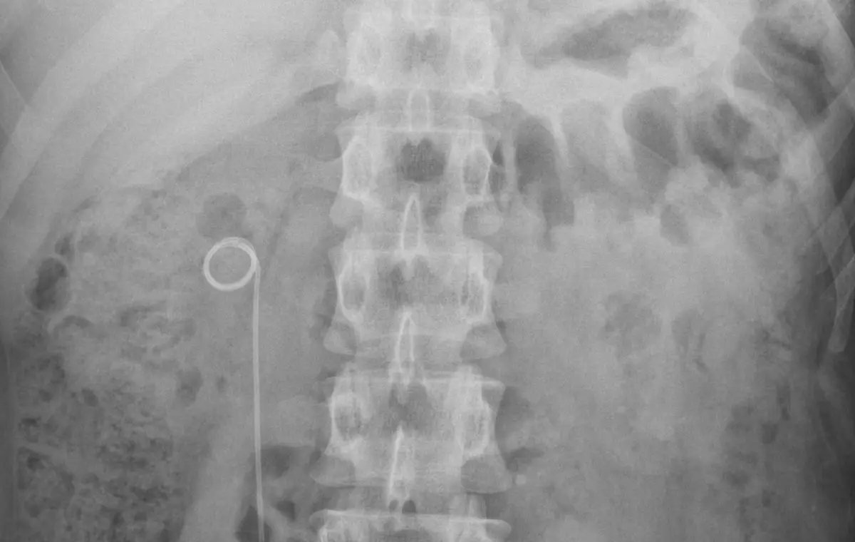 Plain abdominal X-ray after treatment showing a stent in one kidney and no remaining stones.