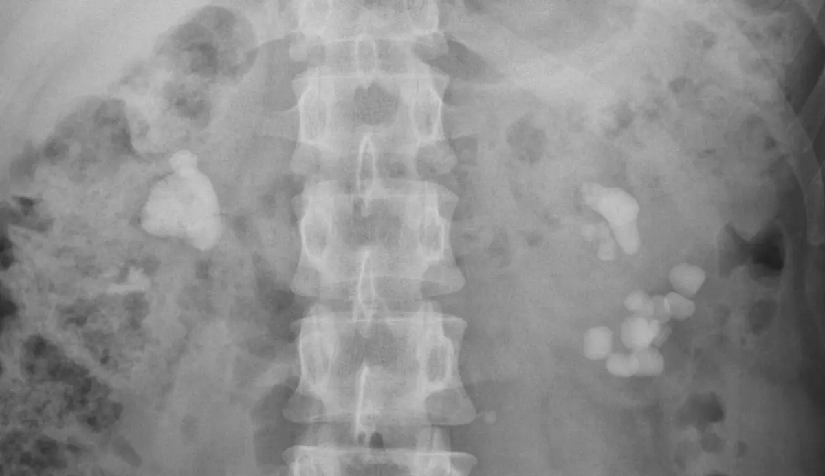 Plain abdominal X-ray showing a large branching stone in one kidney and a cluster of many stones in the other.