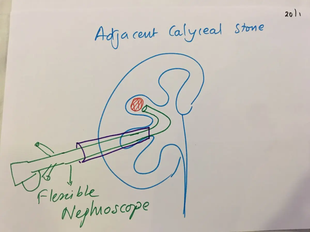 Hand-drawn diagram of a flexible nephroscope passed through a tract and bent into the adjacent calyx to reach a stone.