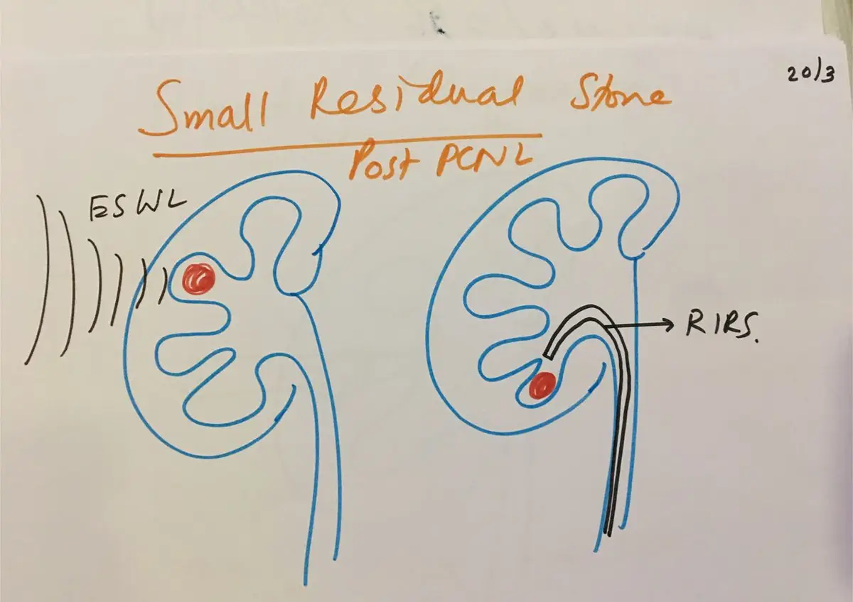 Hand-drawn diagrams showing a small leftover stone treated from outside by shock waves, and another reached by a flexible scope from below.