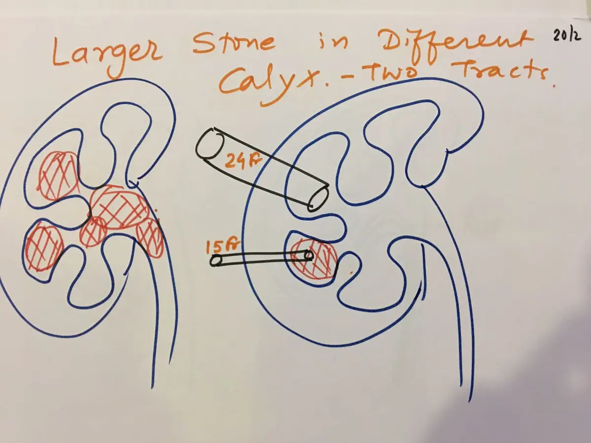 Hand-drawn diagram of a kidney with large stones in different calyces reached by two separate tracts of different sizes.
