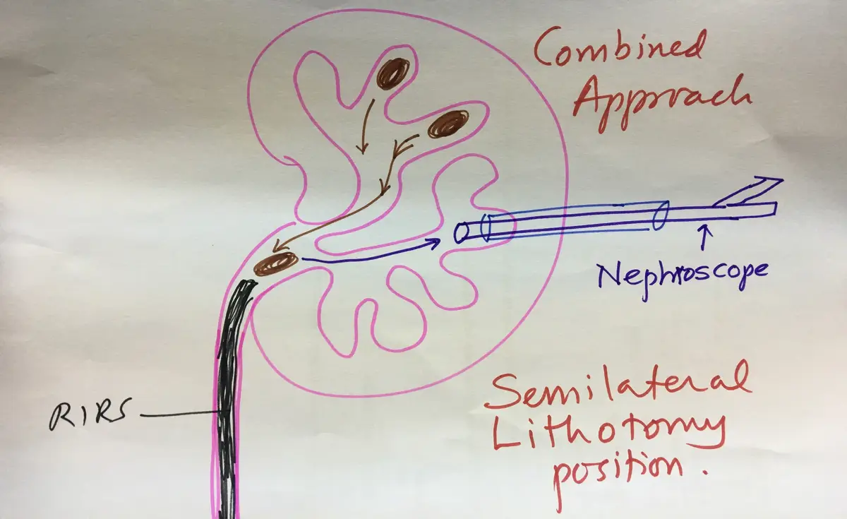 Hand-drawn kidney with a nephroscope entering from the side and a flexible scope entering from below through the ureter, labelled combined approach, semi-lateral lithotomy position.