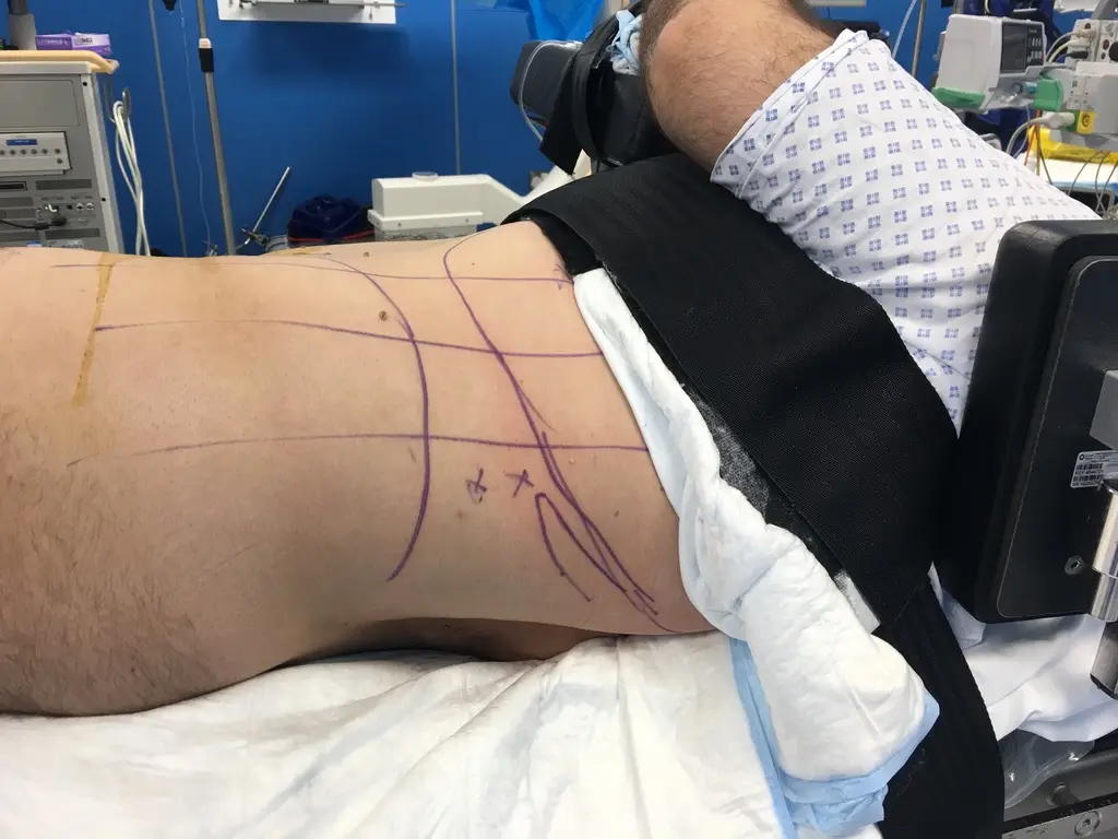 The side of a patient lying on their back, with purple pen lines marking the ribs, hip bone and axillary lines, and a small cross for the planned entry.