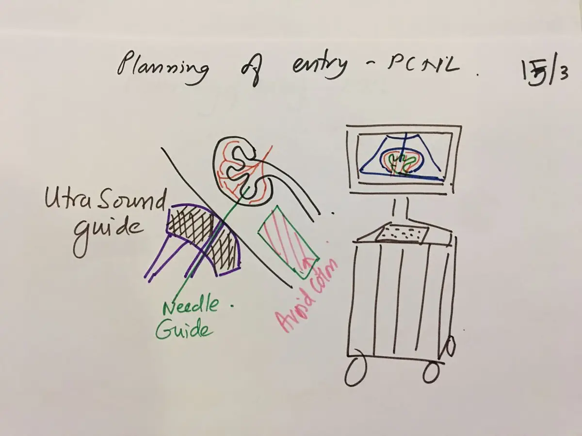 Hand-drawn sketch showing an ultrasound probe with a needle guide on the side of the body, a needle reaching the kidney, and a shaded area marked avoid colon.