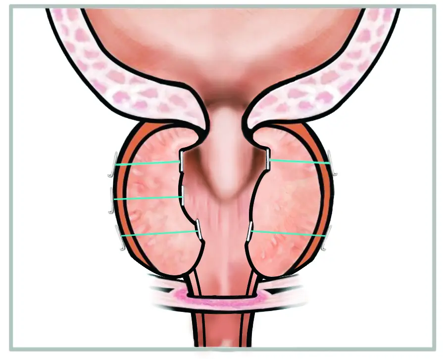 Drawing of the prostate seen from the front, with three pairs of implants pulling the side lobes outward so the channel down the middle is open.