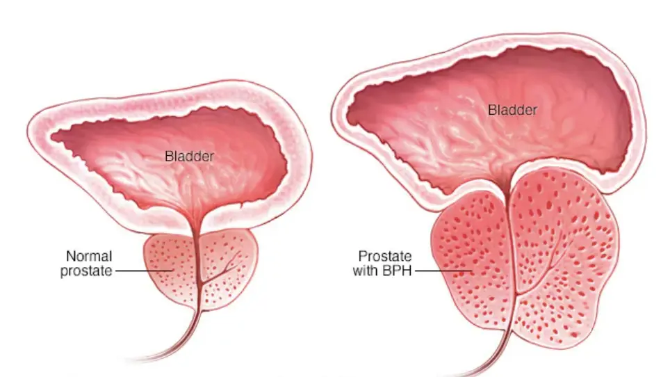 Two drawings of the bladder and prostate: on the left a normal prostate, on the right an enlarged prostate pressing on the channel below the bladder.