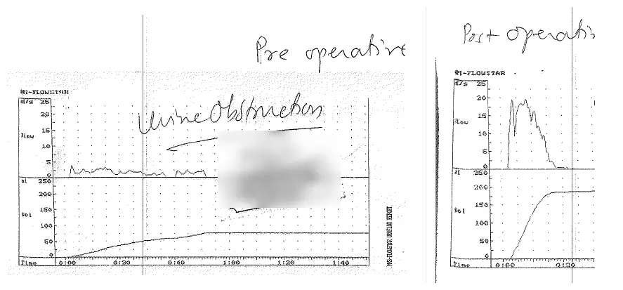 Two urine flow graphs. The first, marked pre-operative, shows a low flat flow line. The second, marked post-operative, shows a tall peak.